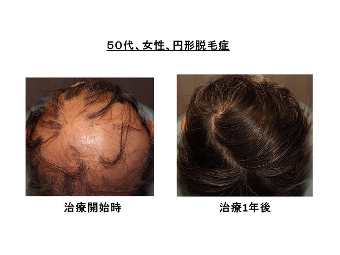 円形脱毛症　病院""